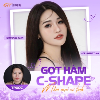 Phẫu thuật khuôn mặt V-line: Từ A-Z về kỹ thuật gọt hàm thon gọn đang được ưa chuộng nhất hiện nay