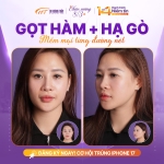Hạ gò má cao: Giải pháp cân đối khuôn mặt hiệu quả