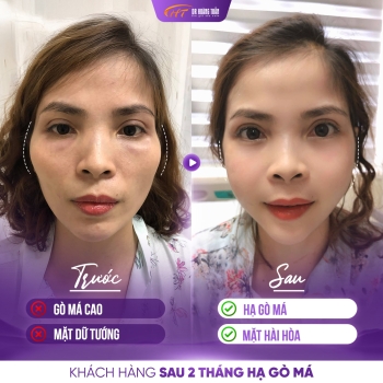 Hạ gò má có bị lệch không và cách phòng tránh hiệu quả