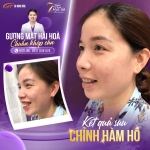 Phẫu thuật chỉnh hô ở đâu uy tín? Tiêu chí lựa chọn địa chỉ an toàn